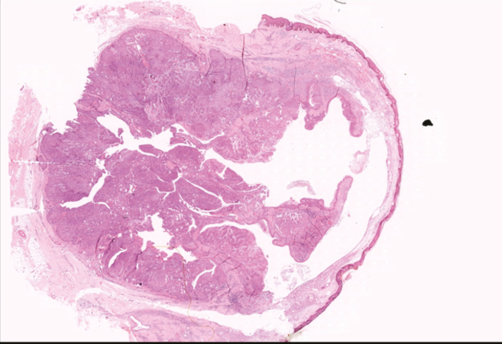 H&E scanner view showing well circumscribed solid and cystic lesion