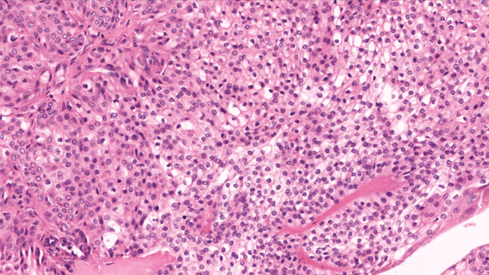 H&E 400× showing polygonal cells with eosinophilic and clear cytoplasm