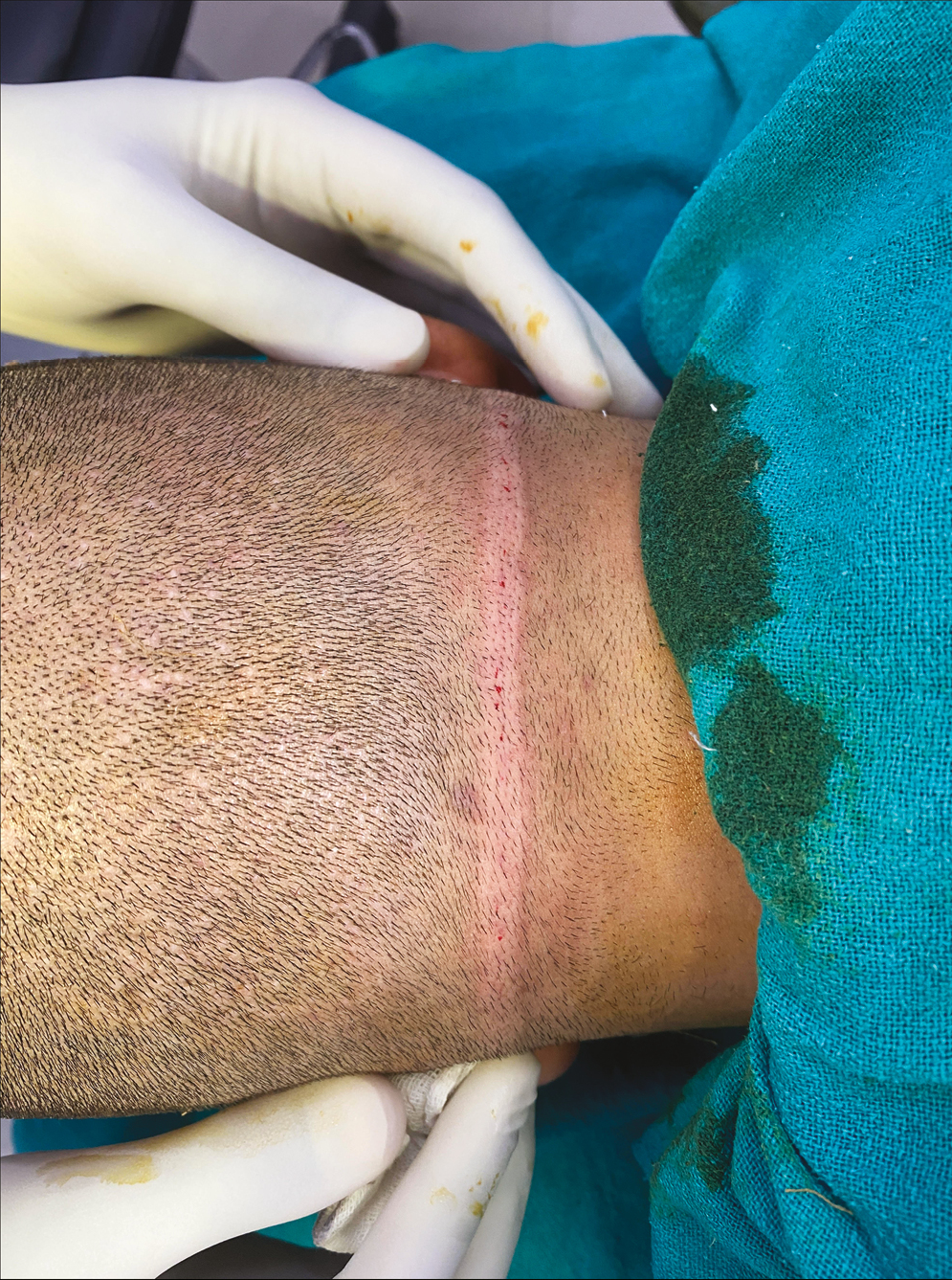 Continuous linear wheal following intradermal injection of local anesthetic in the donor area