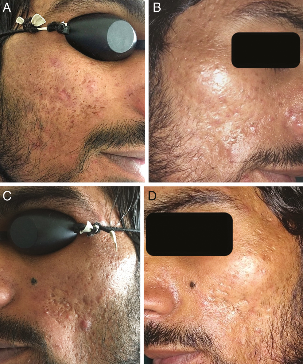 (A) Acne scars over cheeks before treatment sessions. (B) Significant improvement in scarring seen following four sessions of fractional CO2 laser at 6 months. (C) Mixed types of scars over the cheek before treatment. (D) Significant improvement after treatment sessions