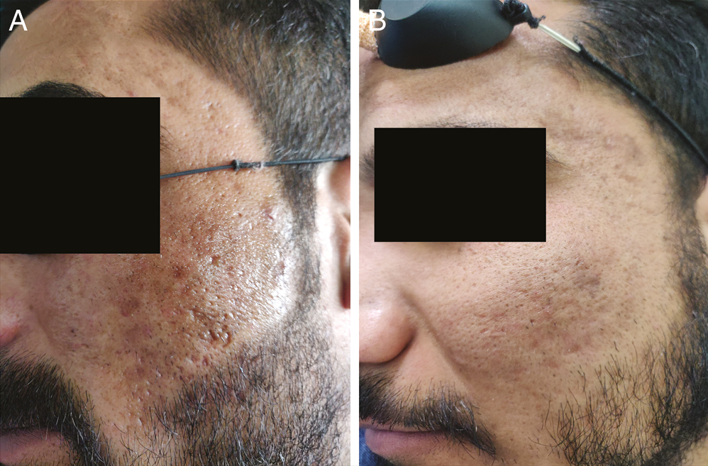 (A) Rolling and boxcar scars over cheeks before treatment. (B) Improvement in scars after four sessions of fractional laser