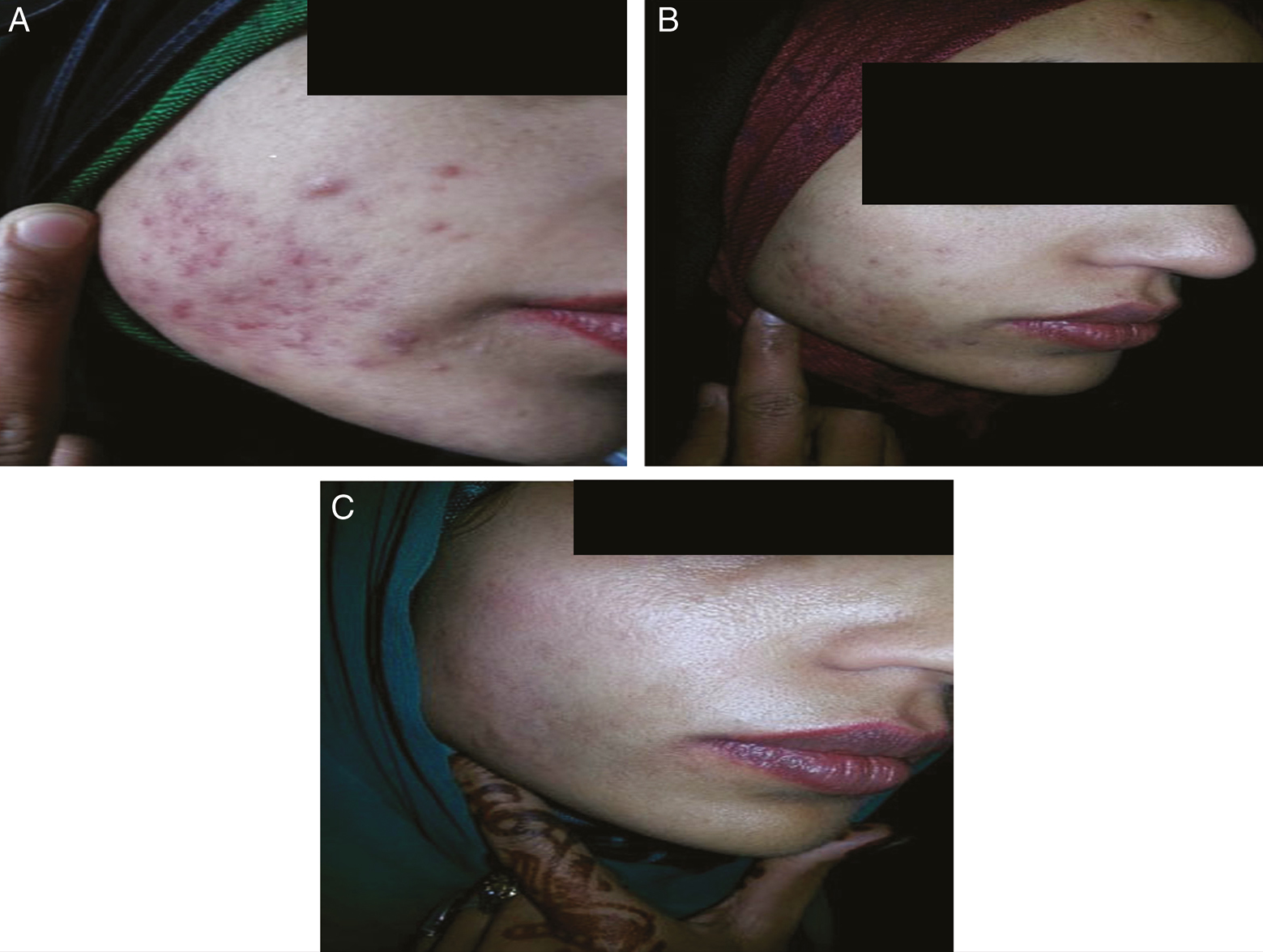 (A) Acne scars over cheeks before laser sessions. (B) Improvement in scars after four sessions of fractional laser therapy. (C) Excellent response after 6 months of four sessions of fractional CO2 laser