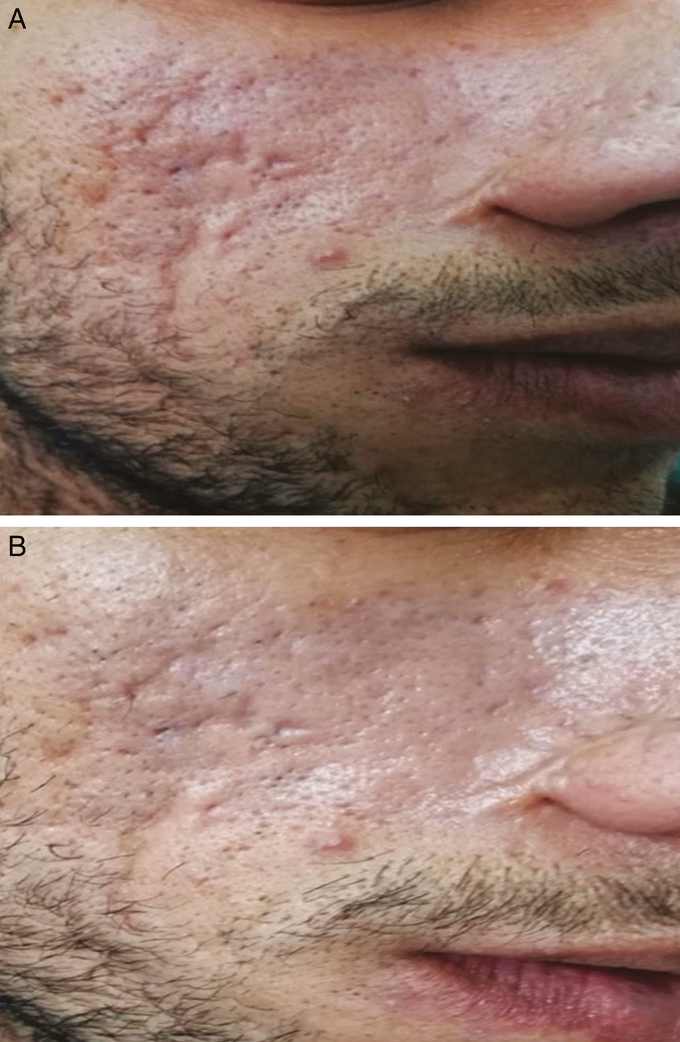 (A) Mixed types of scars over cheeks before treatment. (B) Mild response after four sessions of therapy