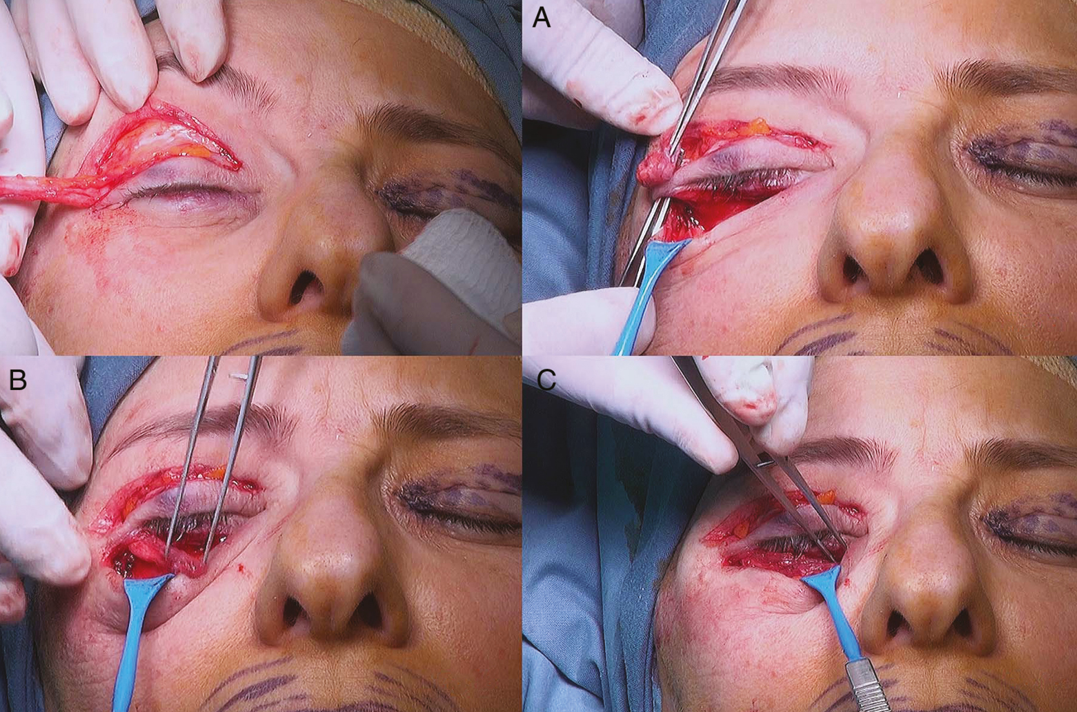 An intraoperative image of a 42-year-old patient. Mobilization of the musculofascial flap of the upper eyelid. (A) Creation of subcutaneous “tunnel” under the skin of lateral canthus. (B) Carrying of the flap through the “tunnel” on the lower eyelid. (C) Placing a flap on the projection of the preseptal portion of the orbicularis muscle