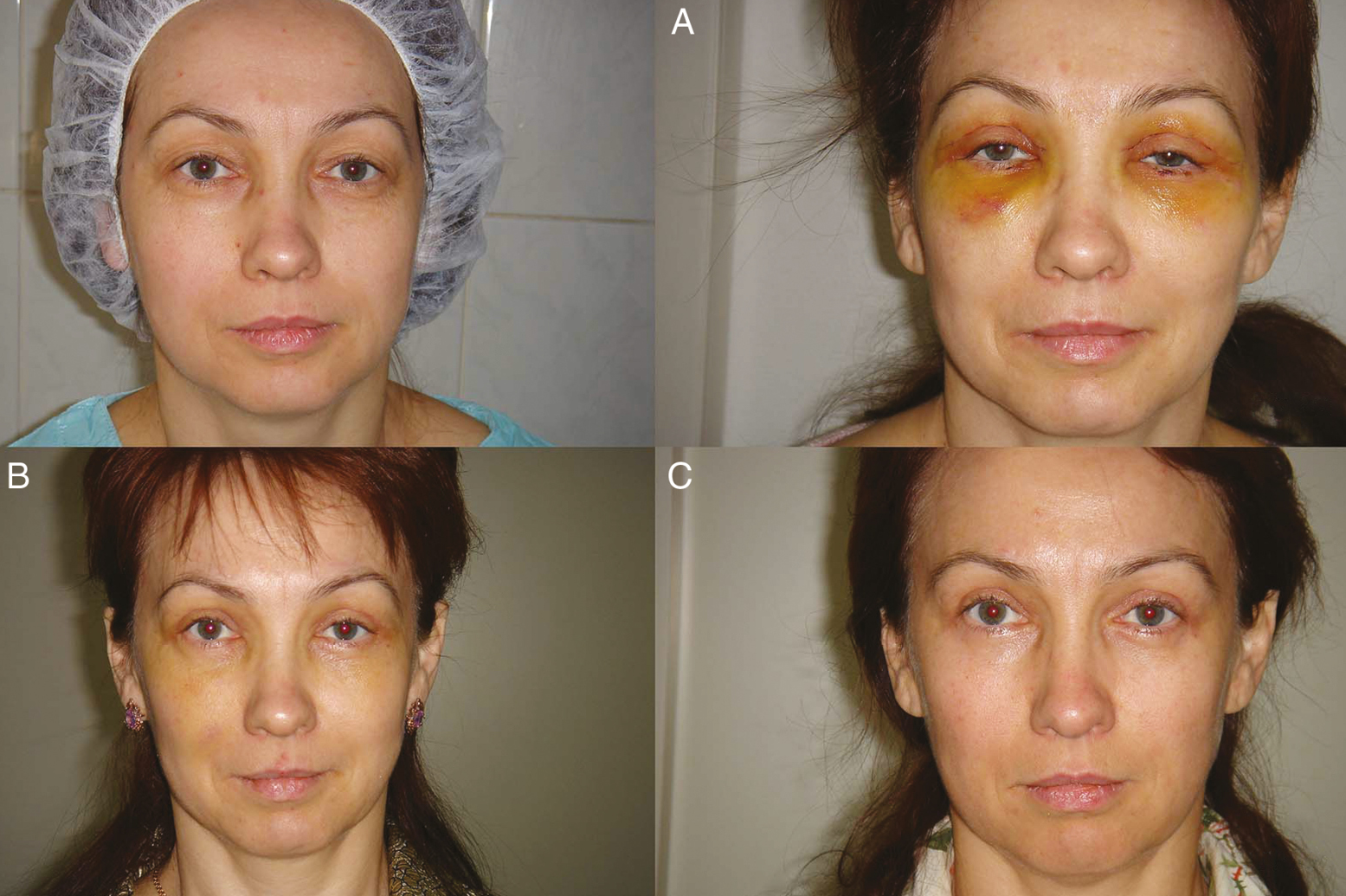 40-year-old patient before the operation. Patient has “emptied” eyelid with a hypertrophic of the pretarsal portion of the orbicularis muscle. This condition was the result of transconjunctival blepharoplasty. (A) Patient after the musculofascial flap transfer from the upper to the lower lid. Patient photo after the removal of sutures. (B) Condition after two months from the operation. (C) Condition after six months from the operation: The transferred flap could not fill the defect on the left eyelid since the thickness of the flap did not correspond to the defect volume