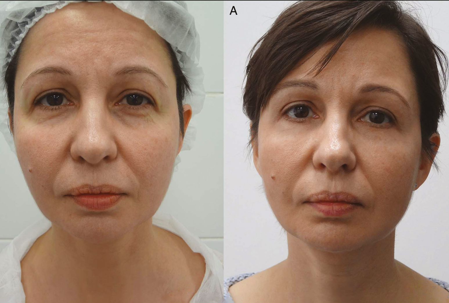 Before the operation of a 47-year-old patient. “Emptied” eyelid and the condition after a classic lower blepharoplasty. (A) Six months postoperation with the offered technique