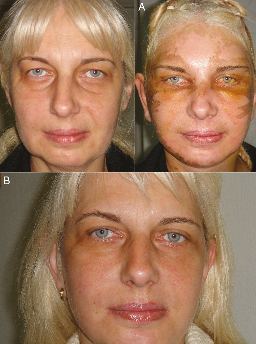 Before the operation of a 59-year-old patient. Wrinkles on the face and neck, and clear “emptiness” of the lower eyelids of involutional etiology. (A) Condition 9 days after operation: SMAS (superficial musculoaponeurotic system) rhytidoplasty, upper, and lower blepharoplasty, the transfer of musculofascial flap from the upper lid to the lower one, and facial skin peeling TCA (trichloroacetic acid) 25%. (B) Seven months after the operation