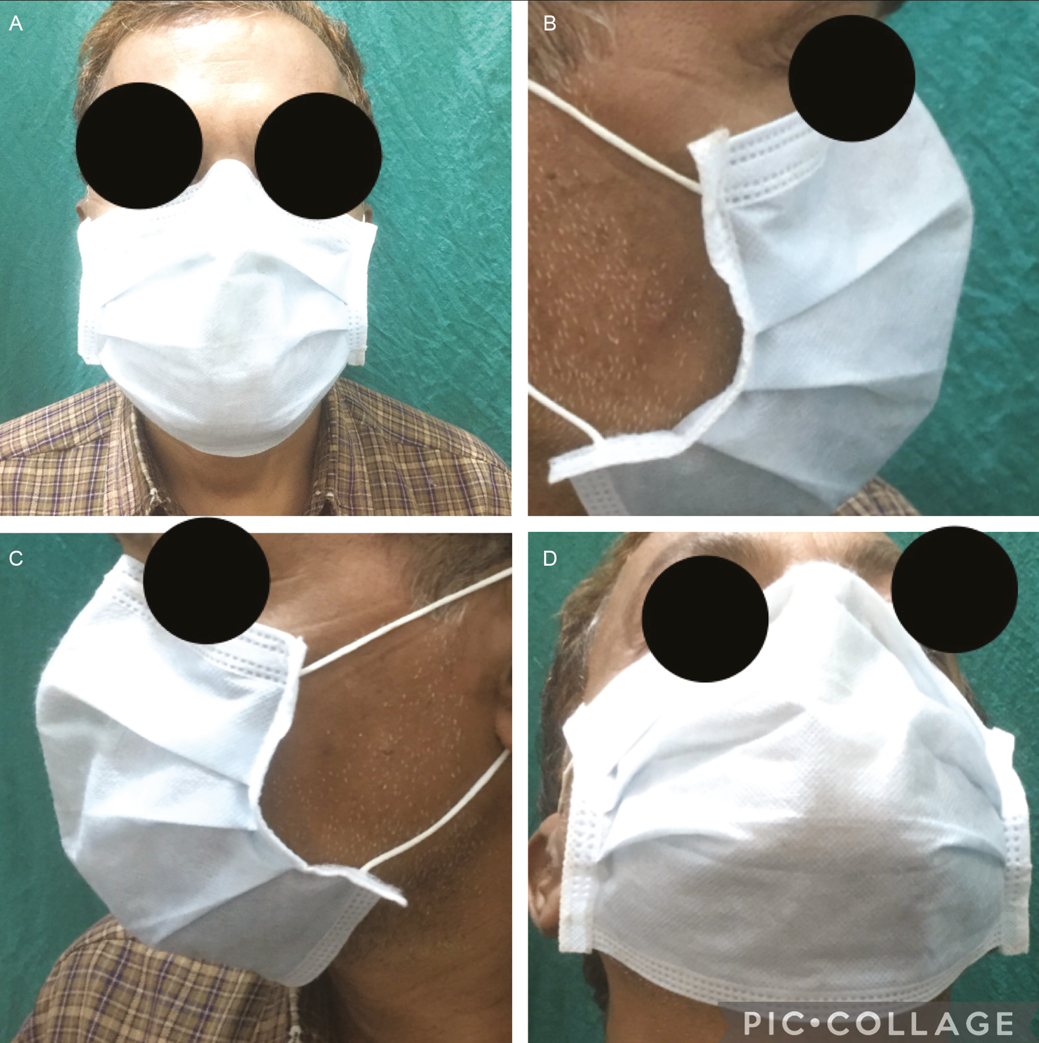 The mask put on the face in its original form showing the mask covers the major parts of the face (A); the mask and its loose border (B–D)