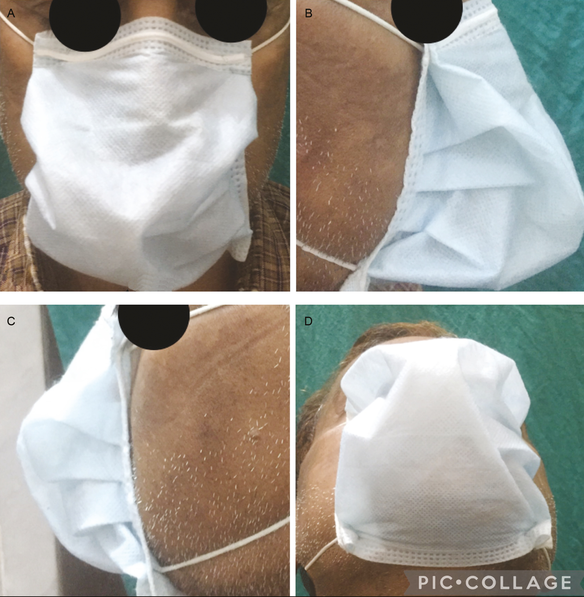 The modified mask is tightly fit and covers the nose, mouth, and chin, exposing an extra part of the face (A–D)