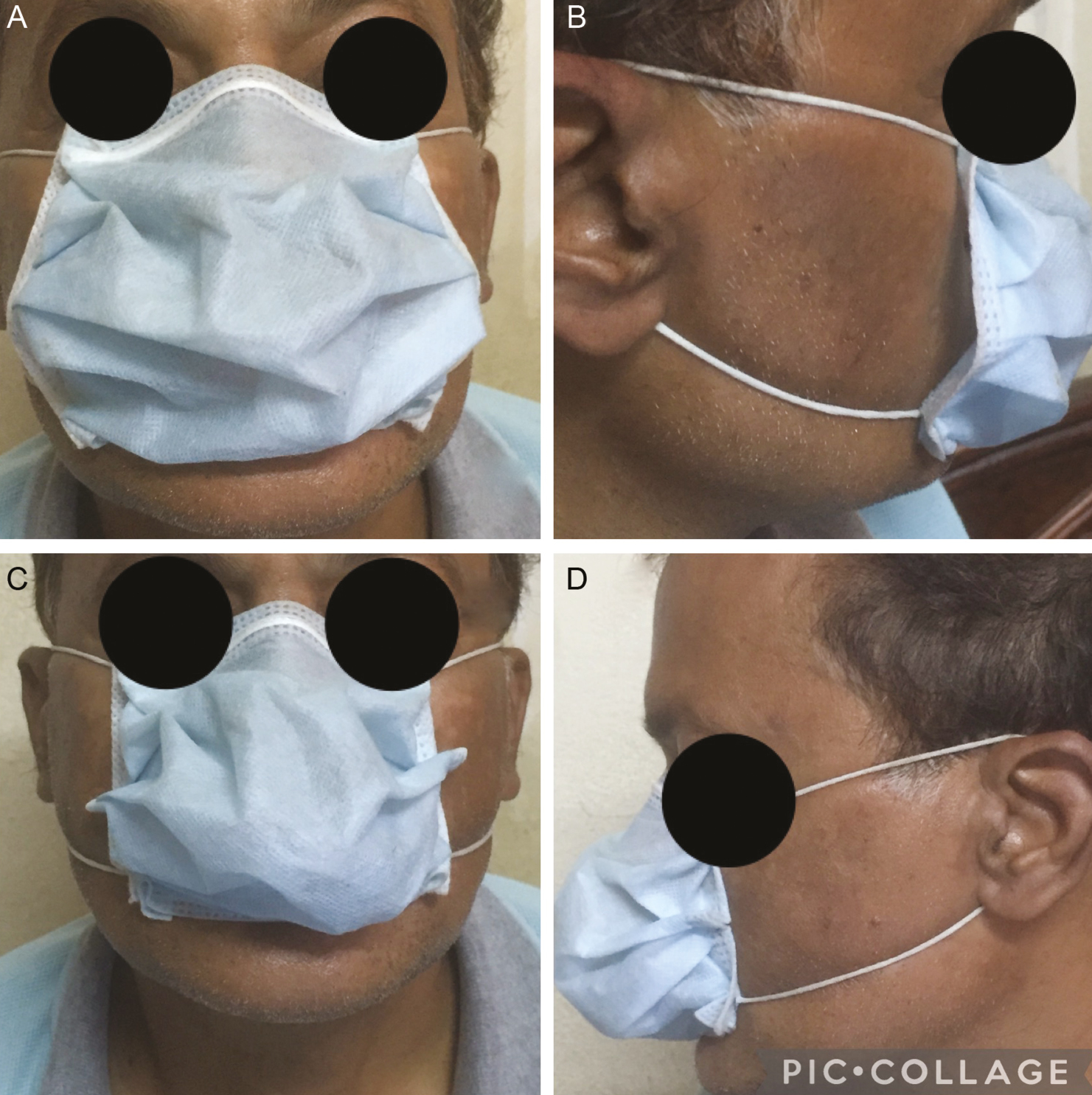 The lateral border of the modified mask is made compact by stapling after keeping its lower border on mentolabial sulcus (A–D)