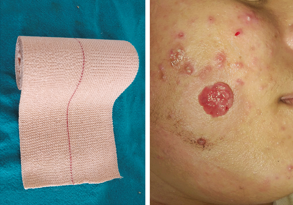 Pyogenic granuloma—decreased vascularity and size after the use of pressure therapy with an elastic adhesive bandage