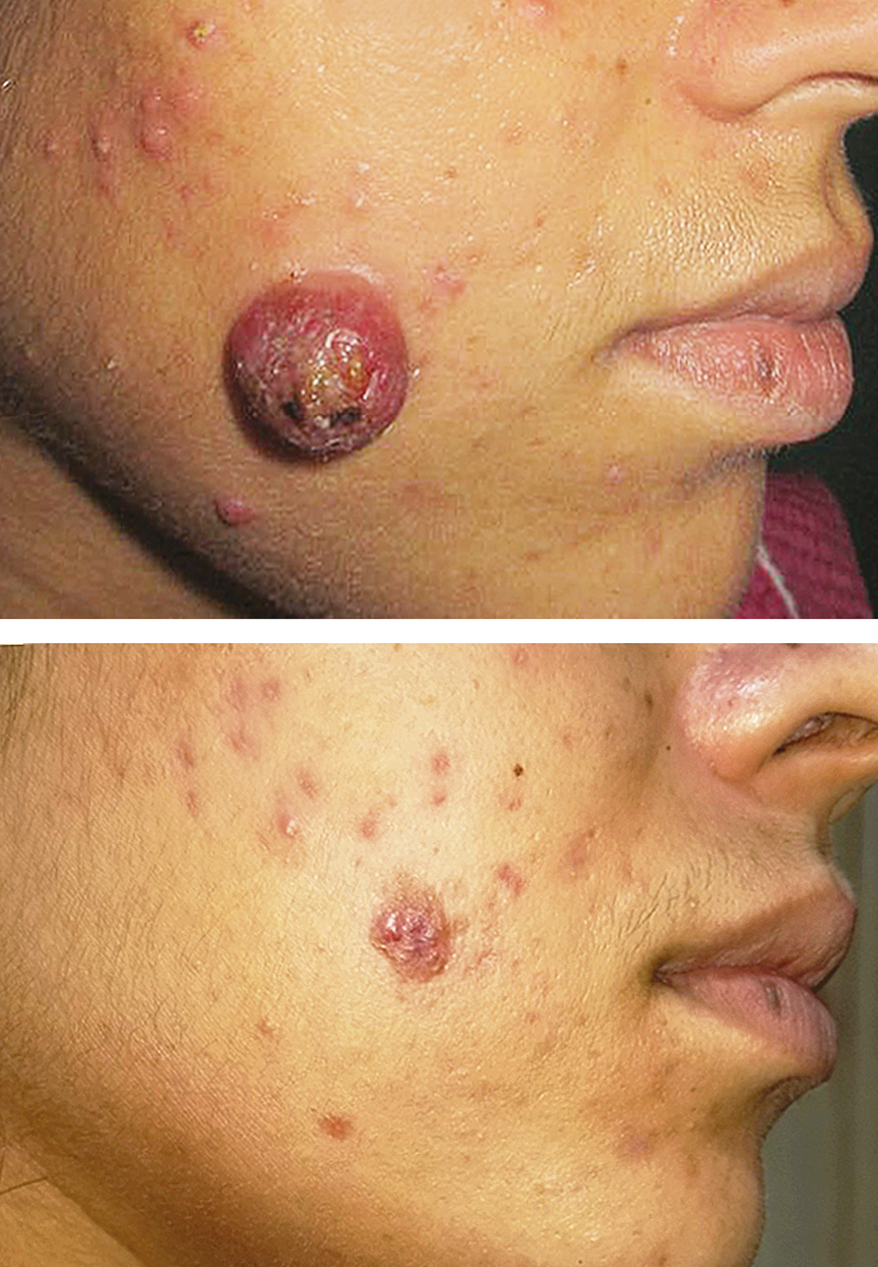 Disfiguring pyogenic granuloma removed with minimal scar