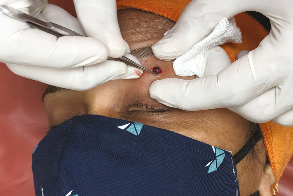 Removal of VL using a toothed pair of forceps