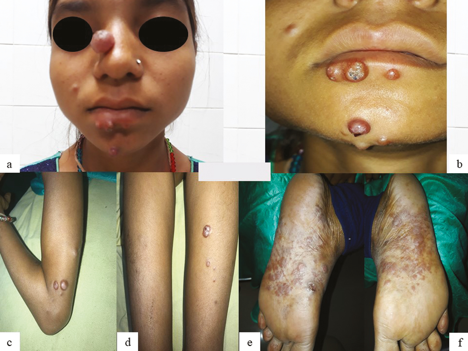 (A–F) Erythematous nodules over chin, nose, bilateral arms, and thigh along with plaque-like lesion over the sole