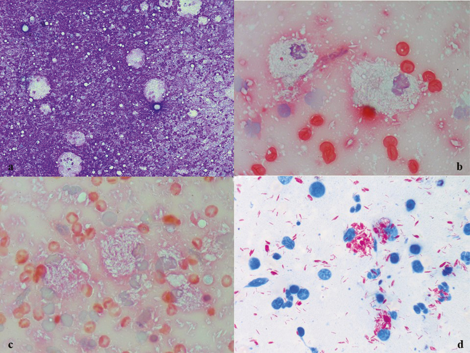 (A–C) Scattered foamy macrophages and neutrophils with extracellular and intracellular negative images of bacilli (Giemsa and PAP ×10, ×40); (D) Bright red positive bacilli (ZN, ×100)