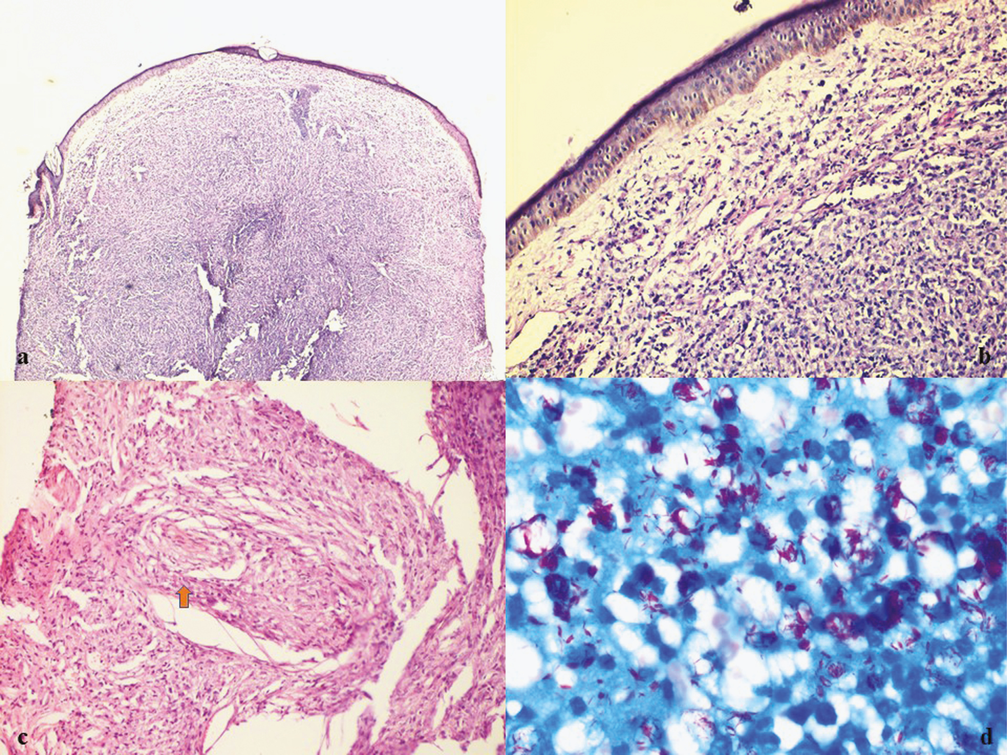 (A–C) Nodular dome-shaped lesion on biopsy with grenz zone. Histopathology showing dense perivascular and perifollicular lymphomononuclear cells infiltrate along with foamy histiocytes (H and E ×10, ×20, ×40); (D) Positive Fite-Faraco stain for lepra bacilli (Fite, ×100)