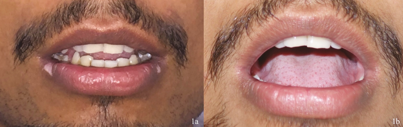 (A) Vitiligo at angle of lip and (B) post 6 months resolution