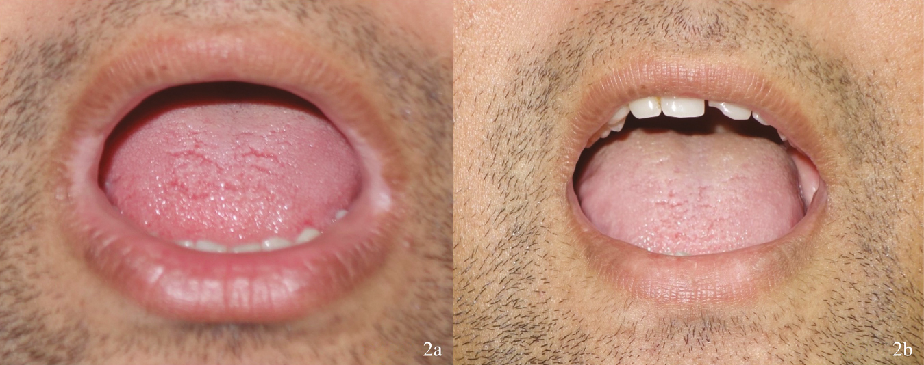 (A) Vitiligo at angle of lip and (B) post 6 months resolution