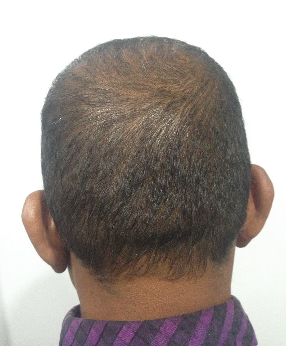 Diffuse thinning