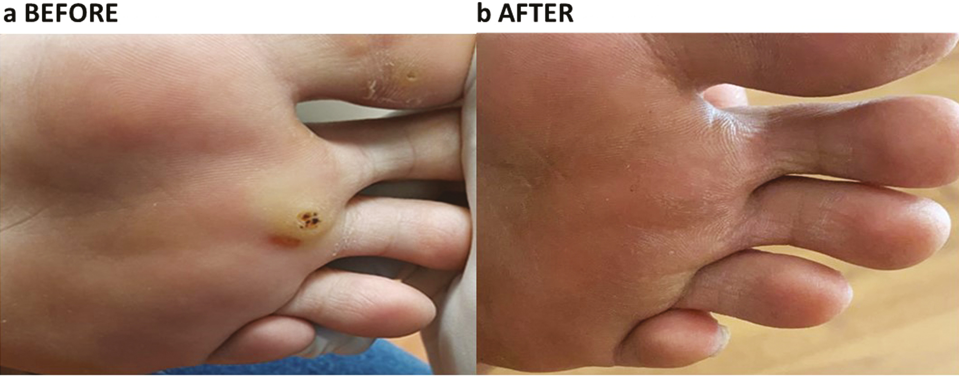 (a, b) Plantar wart before IL Vit D3 treatment. Complete resolution after three sessions of IL Vit D3