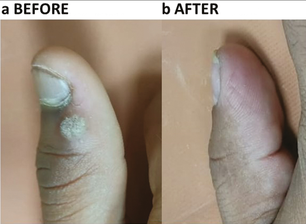 (a, b) Palmar wart before IL Vit D3 treatment. Complete resolution after four sessions of IL Vit D3