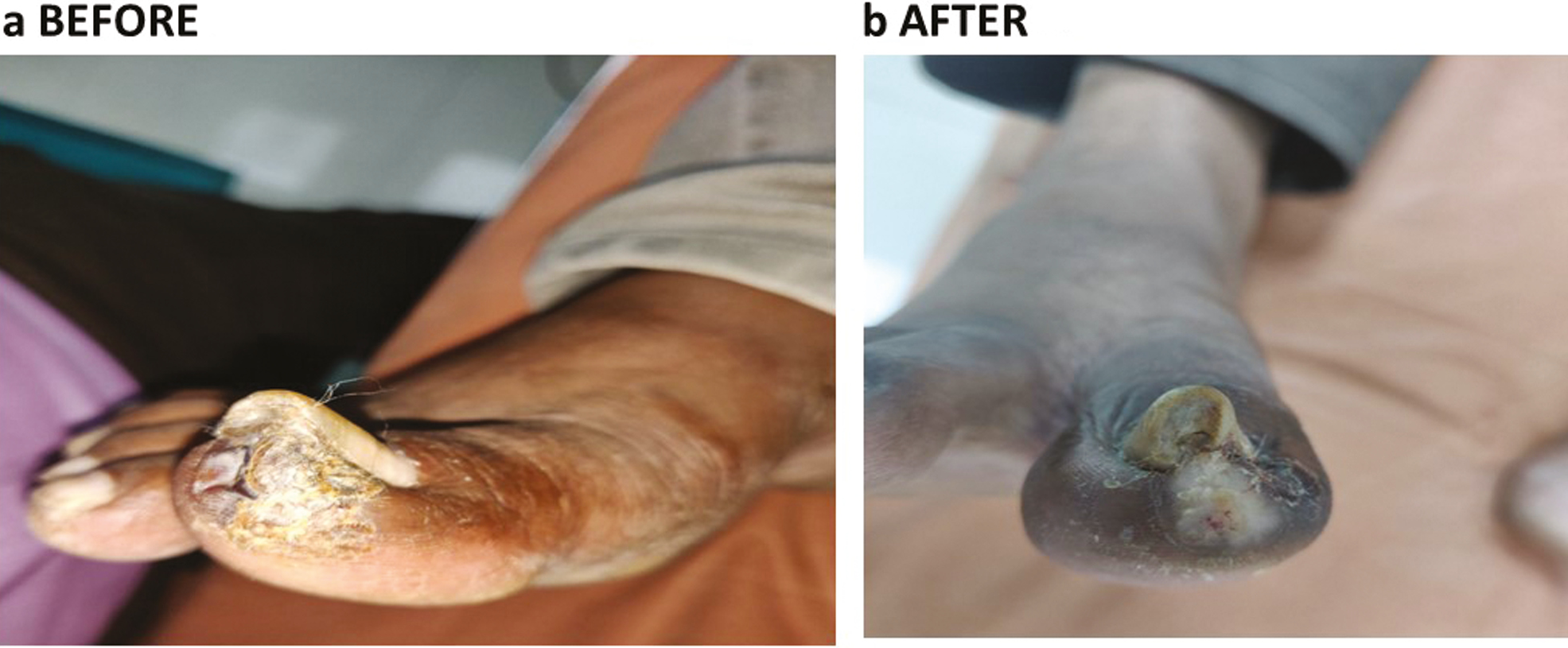 (a, b) Plantar wart before IL Bleomycin, same wart after 4 months of IL Bleomycin