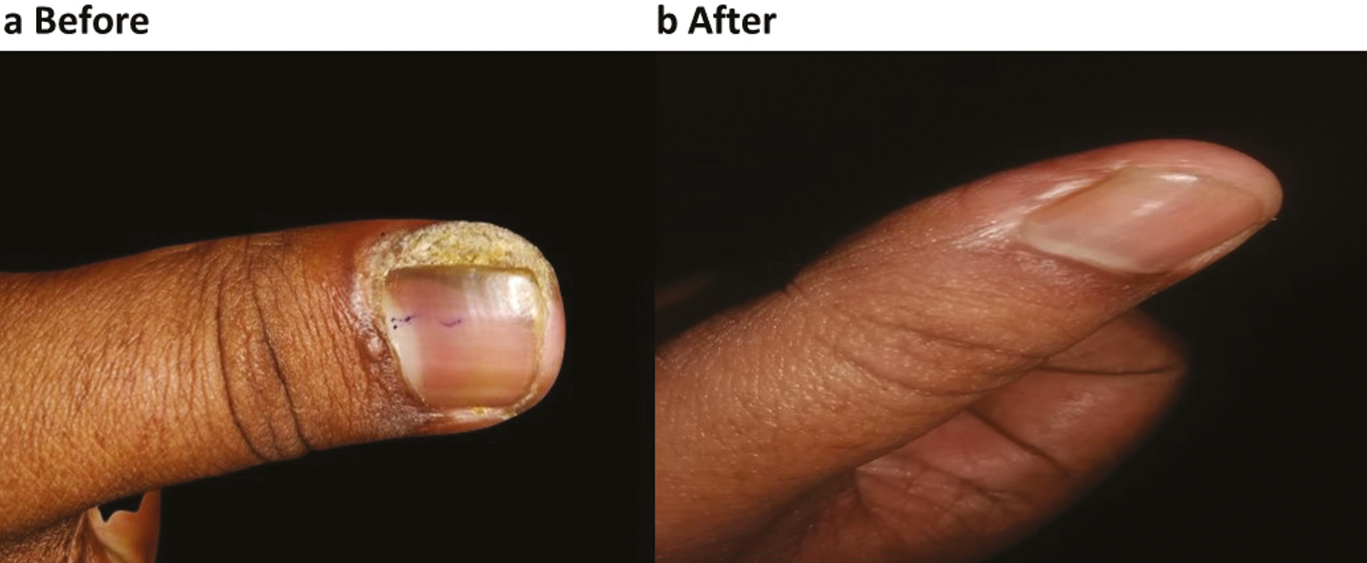 (a, b) Periungual wart before and after 4 months of IL Bleomycin