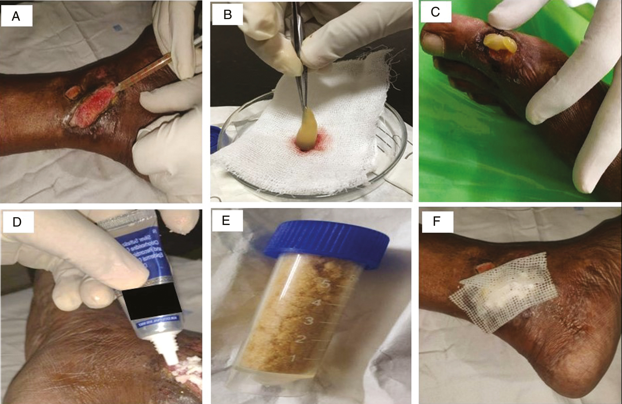 Therapeutic modalities employed for nonhealing ulcer in this study are depicted. (A) Injection of autologous PRP into the base and sides of the ulcer in Group A. (B and C) Separation of PRFM from adherent blood clot and placement over the cleansed wound bed, in Group B. (D) Application of rhEGF cream to the wound in Group C. (E) Collagen particles in Group D to be sprinkled adequately over the wound. (F) Paraffin-impregnated non-adherent gauze dressing applied after the procedure