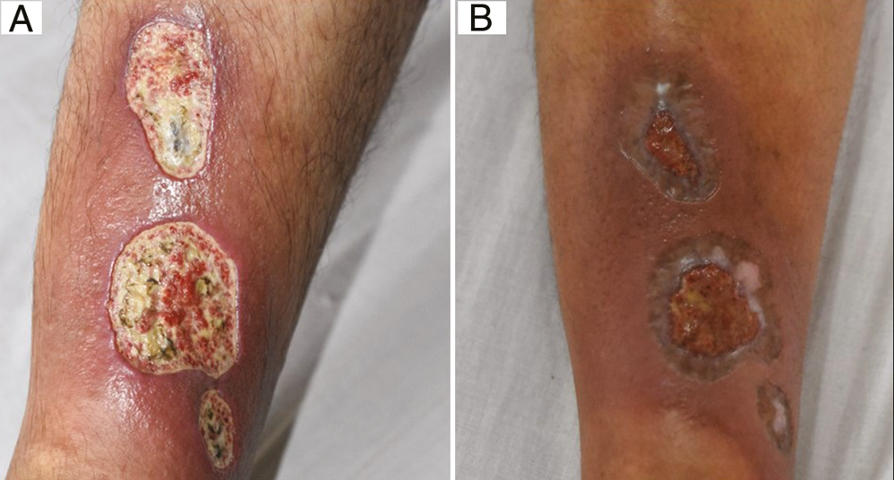 (A) Baseline: Posttraumatic ulcer in a 34-year-old man. (B) Week 8: After six sessions of autologous platelet-rich plasma therapy (Group A)