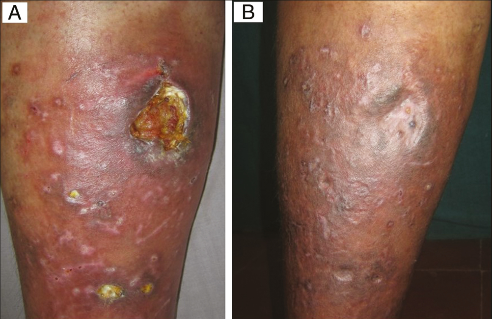 (A) Baseline: Varicose ulcer in a 54-year-old man. (B) Week 8: After four sessions of autologous platelet-rich fibrin therapy (Group B)