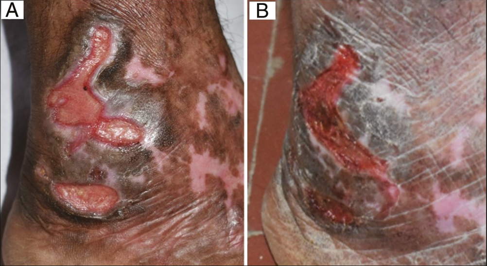 (A) Baseline: Trophic ulcers in a 56-year-old diabetic woman. (B) Week 8: After recombinant human epidermal growth factor application (Group C)