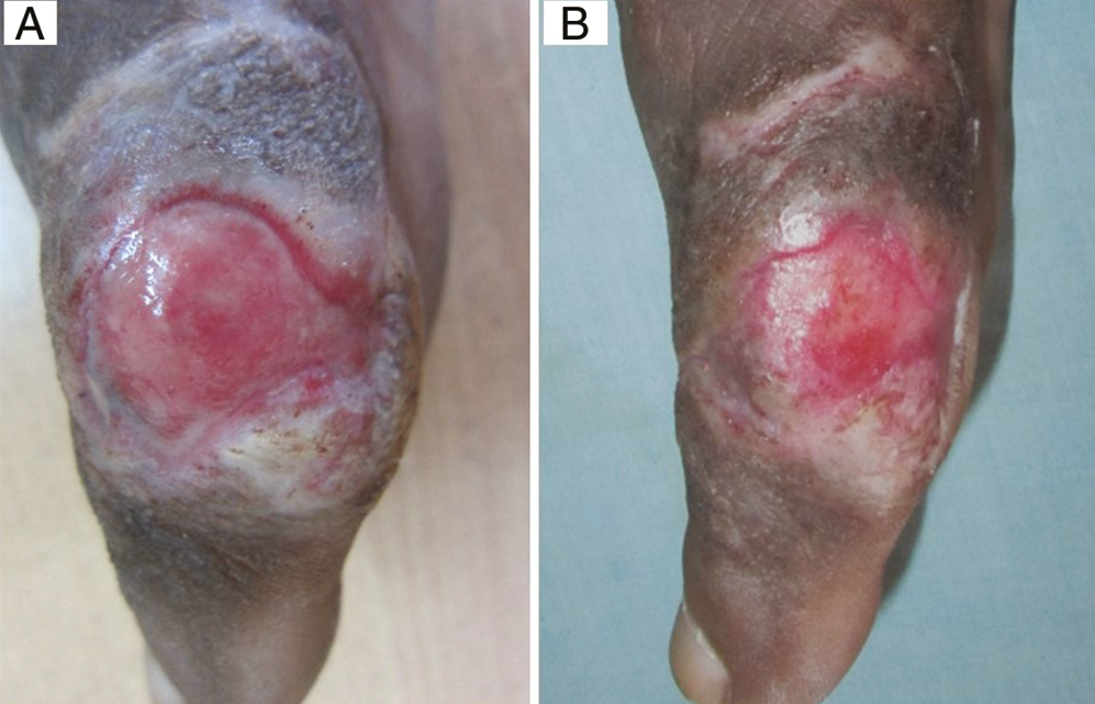 (A) Baseline: Trophic ulcers in a 30-year-old man with leprosy. (B) Week 8: After collagen particle dressing (Group D)