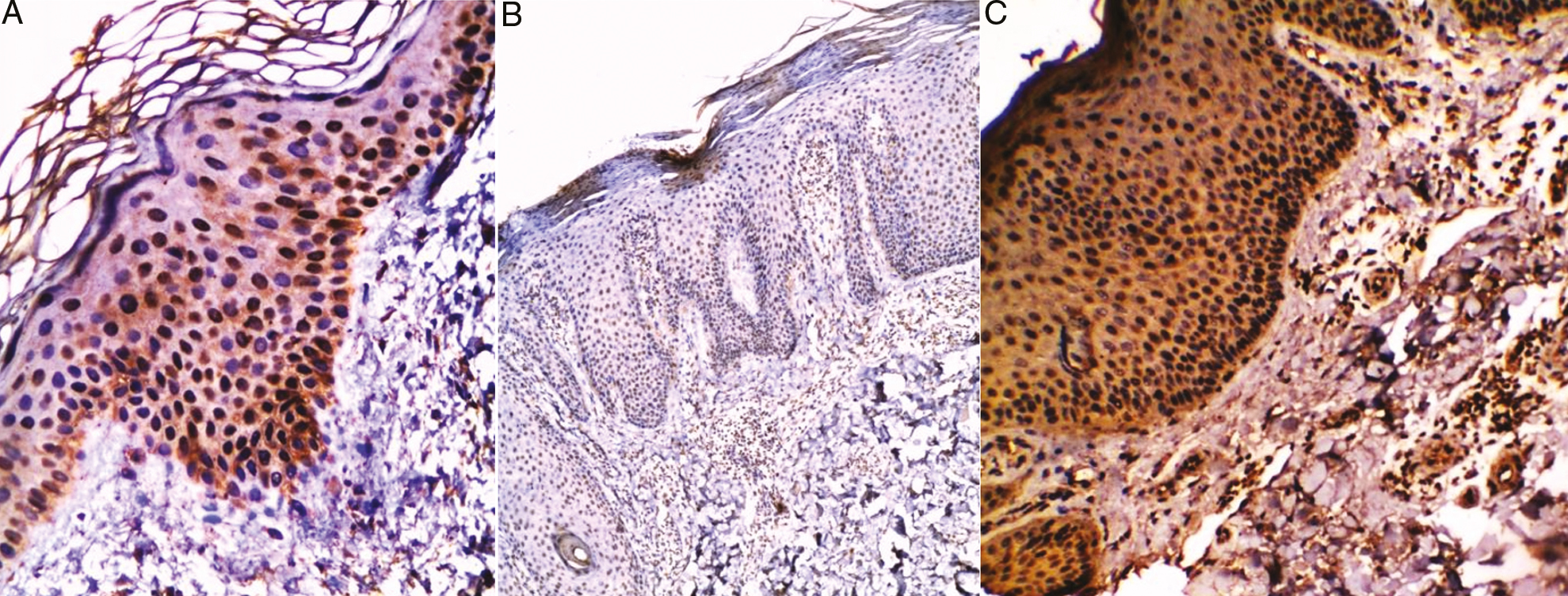 (A) Non lesional skin of chronic plaque psoriasis showed marked (+3) expression of VDR in both basal cell layer and prickle cell layer (streptavidin–biotin ×200). Chronic plaque psoriasis (lesional skin) (B) before treatment with NB-UVB showed mild (+1) expression of VDR in basal cell layer (streptavidin–biotin ×40), (C) after treatment with NB-UVB showed marked (+3) expression of VDR all layers of epidermis (streptavidin–biotin ×100)