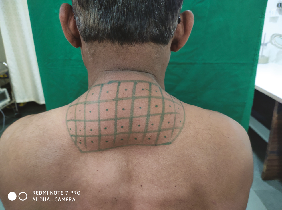 Showing grid marking before injecting DCA intralesionally