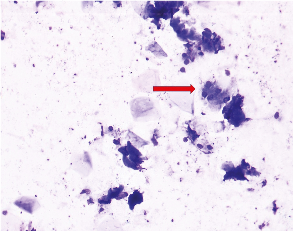 Smear shows intra parotid epidermoid cyst with salivary ductal and acinar cells (red arrow) (MGG stain, 40×)