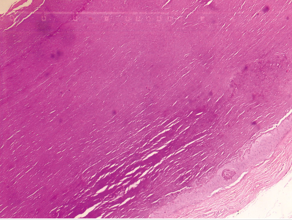 Histopathology of trichilemmal cyst showing absence of granular layer (Hematoxylin and eosin, 10×)