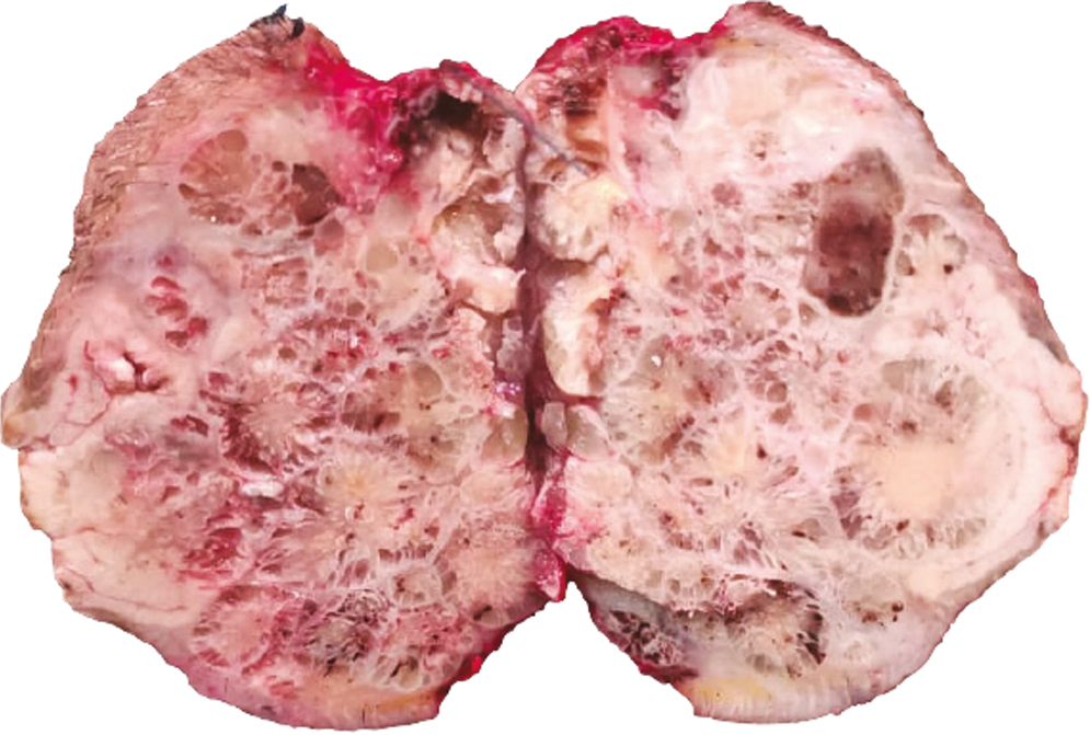 Skin covered well-demarcated cystic mass, pilar tumor at the nape of the neck region (gross image)