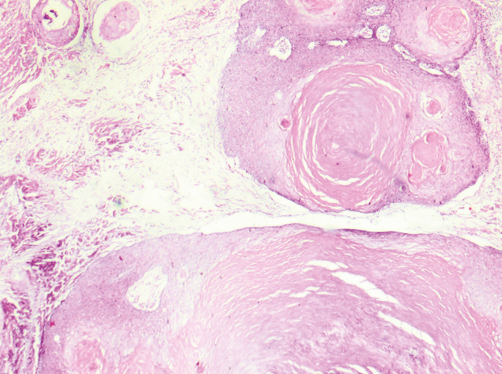 Histopathology of pilar tumor showing bands of squamous epithelium with trichilemmal type keratinization (Hematoxylin and eosin, 10×)