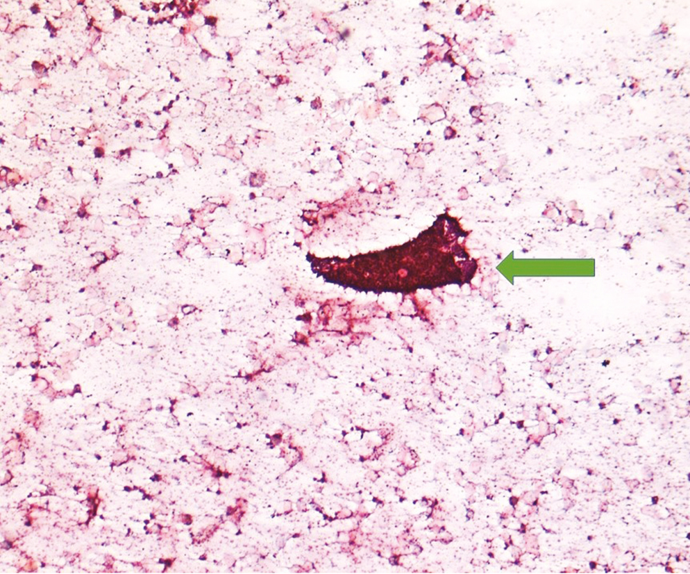 Smear shows intra mammary epidermoid cyst with anucleated squames with tight cohesive clusters of benign ductal epithelial cells (green arrow) (May grunwald giemsa, 10×)