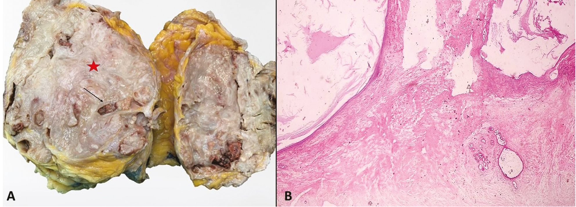 (A) Mastectomy specimen showing solid (red star) and cystic (black arrow) tumor. (B) Histopathology of mastectomy showing solid cystic tumor with features of epidermoid cyst and borderline phyllodes