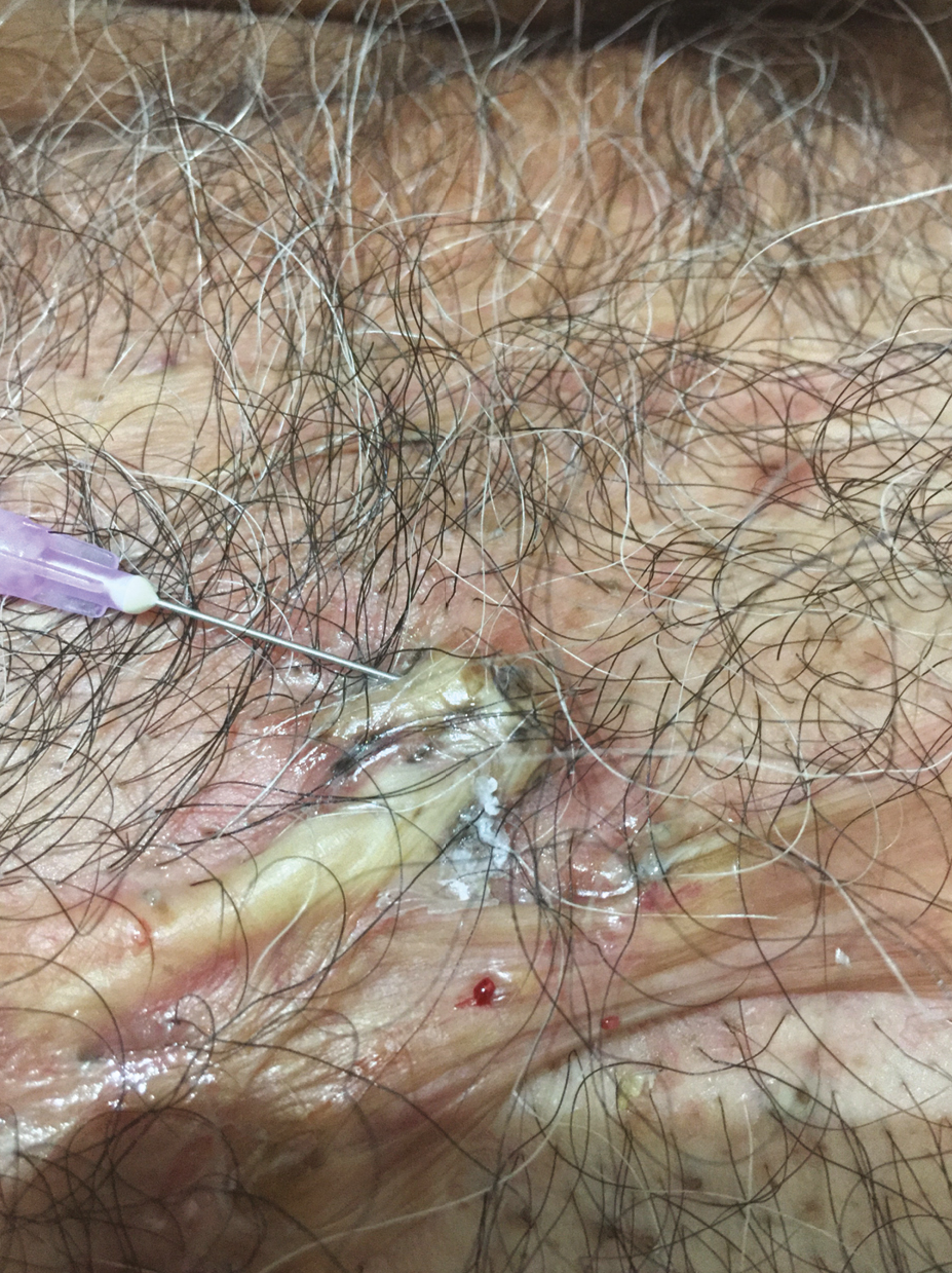 Intralesional injection is given after sealing of follicular openings and comedones on the surface of keloid with cyanoacrylate glue