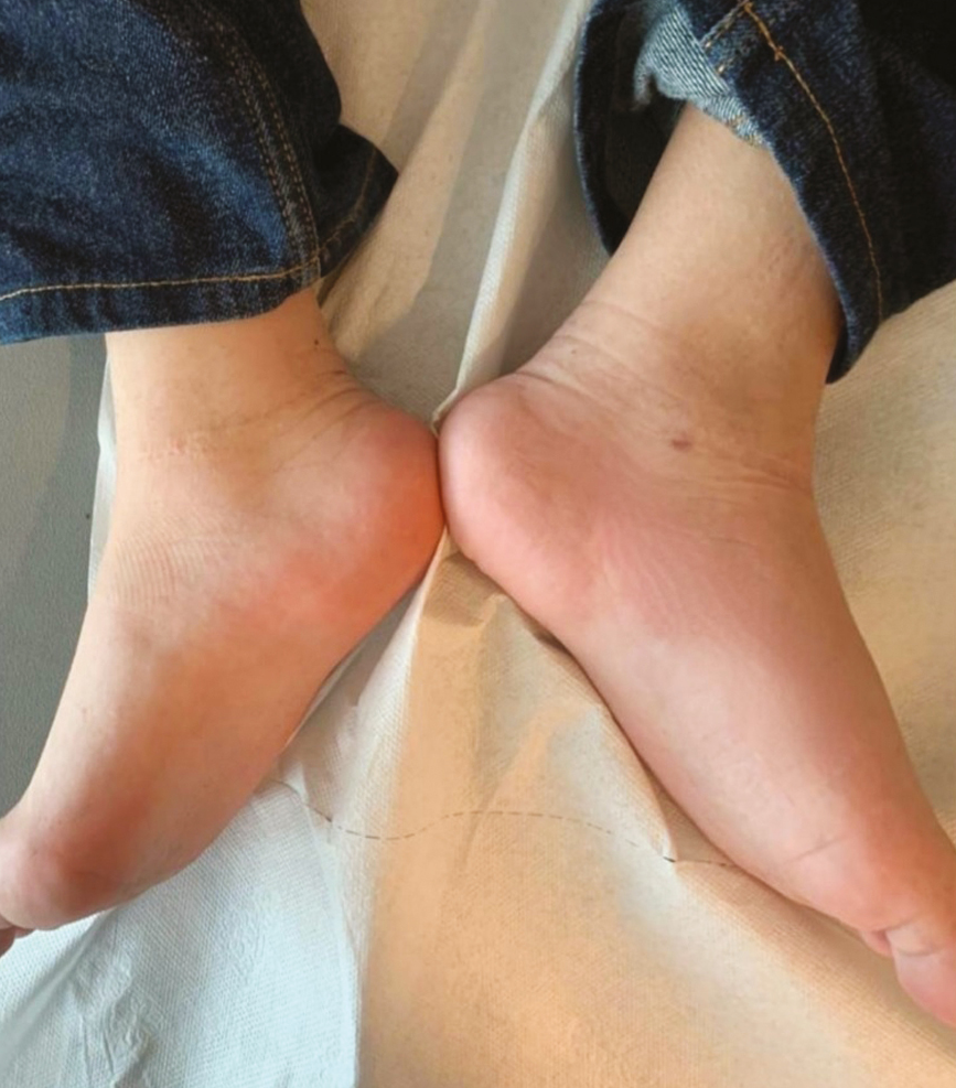 Preoperative image of the lesion on the medial aspect of left foot