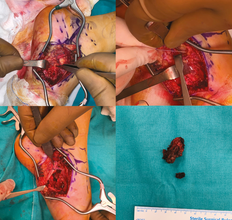 Arteriovenous malformation excision. (A) Tumor identification, (B) diode laser application, (C) excision of the tumor, (D) Tumoral tissue after excision