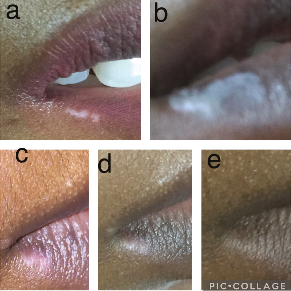 (A) A lesion of vitiligo on lip before TCA cautery. (B) The lesion of the vitiligo after the cautery. (C) The lesion after 2 weeks of cautery. (D) The lesion after 4 weeks of cautery. (E) The lesion after 6 weeks of cautery