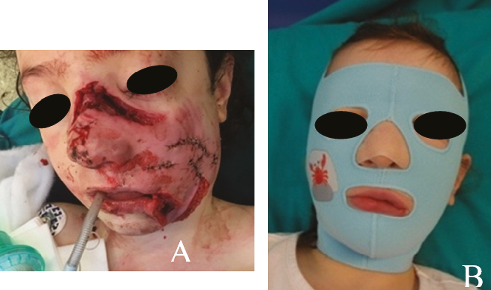 (A) Deep facial wounds with avulsion of soft tissues. Suture of the wounds. (B) Elastic custom facial mask