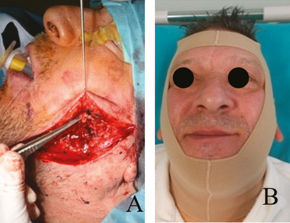 (A) Deep wound produced by stab incision on the left side of the face. (B) Elastic facial custom-made mask