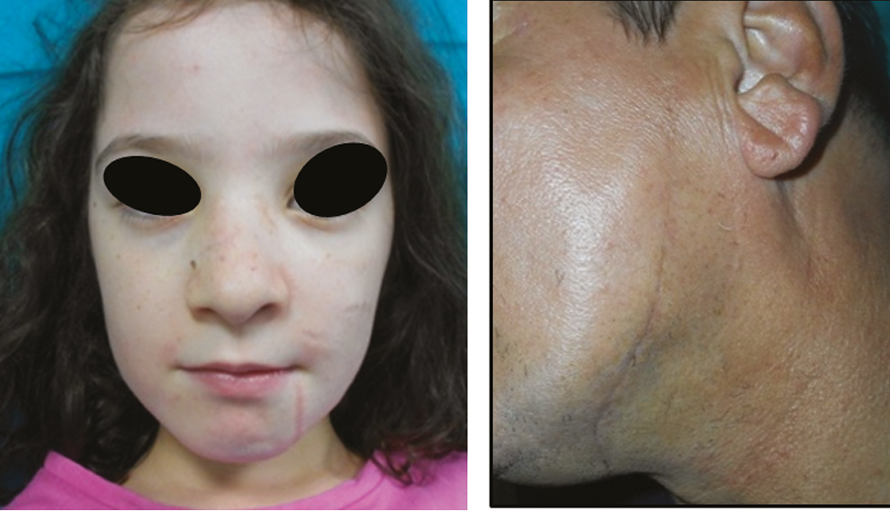 (A) Outcomes 1 year after treatment of 1st case. (B) Outcomes 1 year after treatment of 2nd case