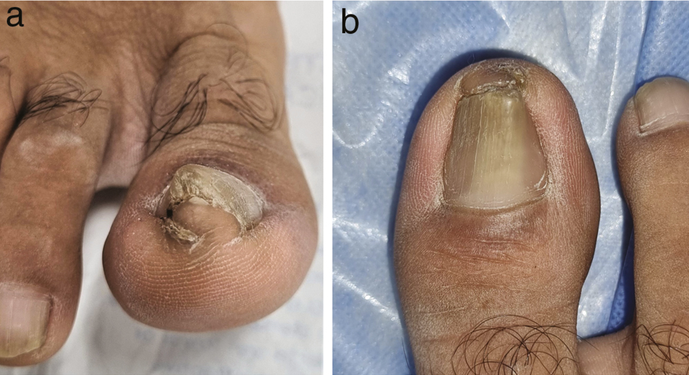 (a,b) Thickened nail plate distally showing a plicated nail morphology with a fissure in the lateral nail fold. Dorsally, the nail plate shows a broad central zone of leukonychia with a distal increase in transverse curvature