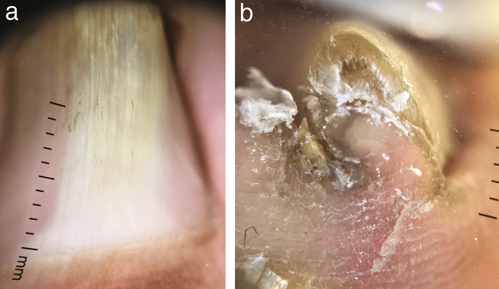 (a,b) Linear broad band of leukonychia with whitish-grey channels running through the nail plate. The distal edge of the thickened nail plate shows compact subungual hyperkeratosis, thickened nail plate, with few cavities identified dorsally (Dermlite DL4×x10 polarized)