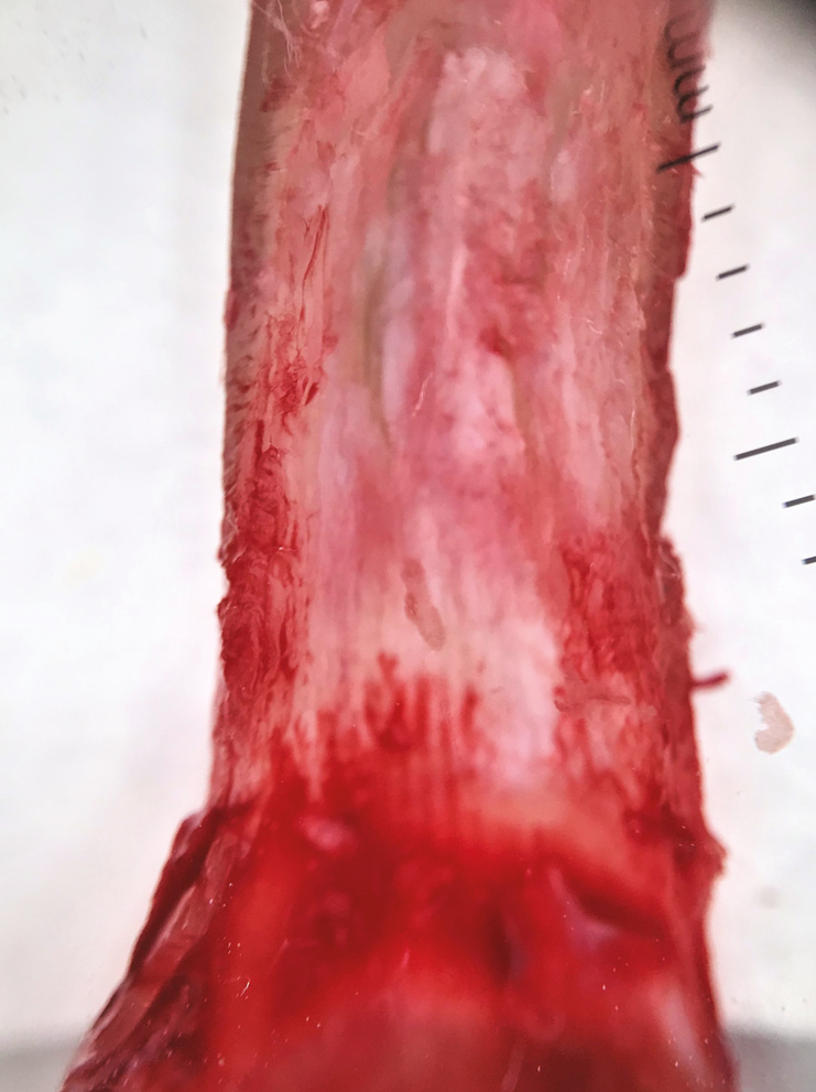 Intraoperative onychoscopy revealed regularly arranged hyperbolic crypts with few filiform projections, seen in the proximal part of the ventral aspect of the nail plate (Dermlite DL4 × 10 polarized)